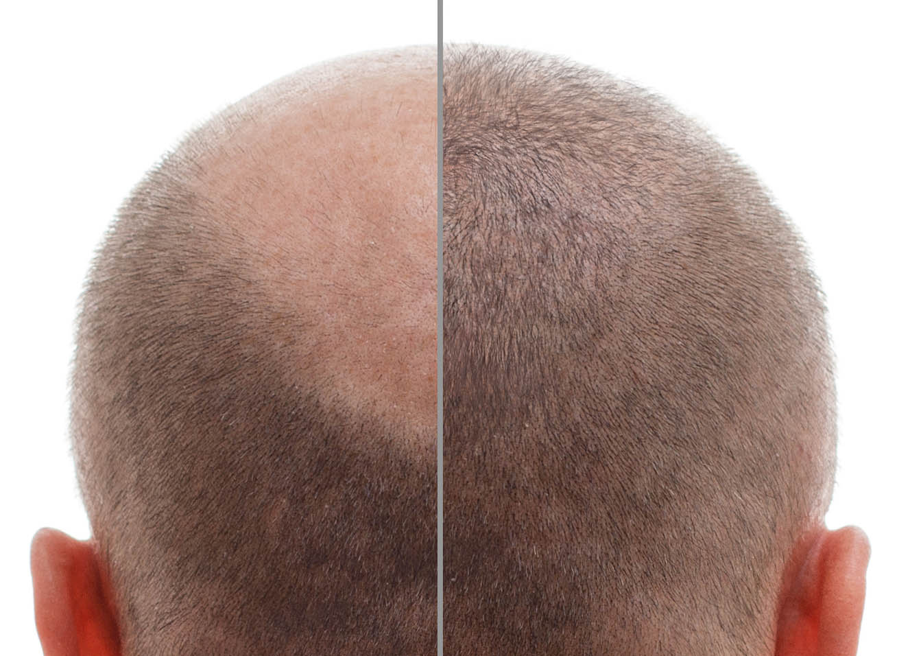 Hair Transplant before and after