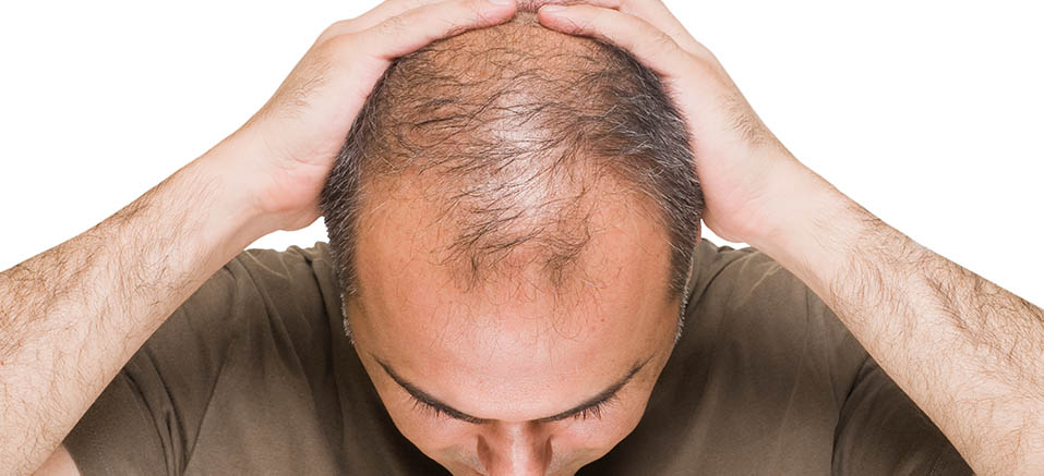 FUE Hair Transplant Before Patient