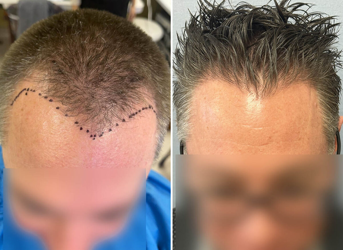 Male Fue Hair Transplant Cova Hair