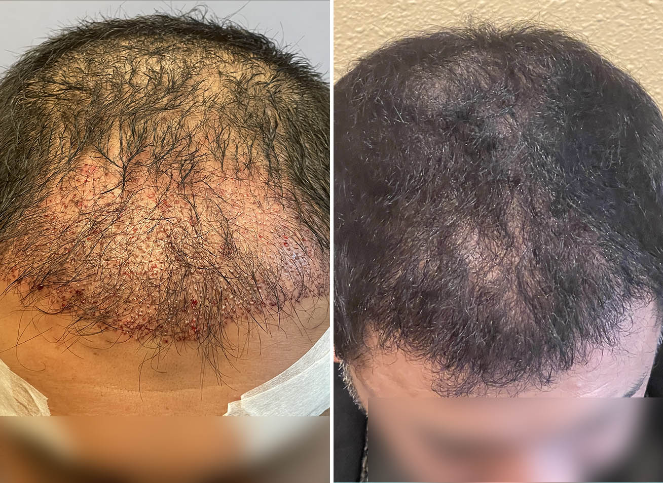 Cova hair transplant before and after