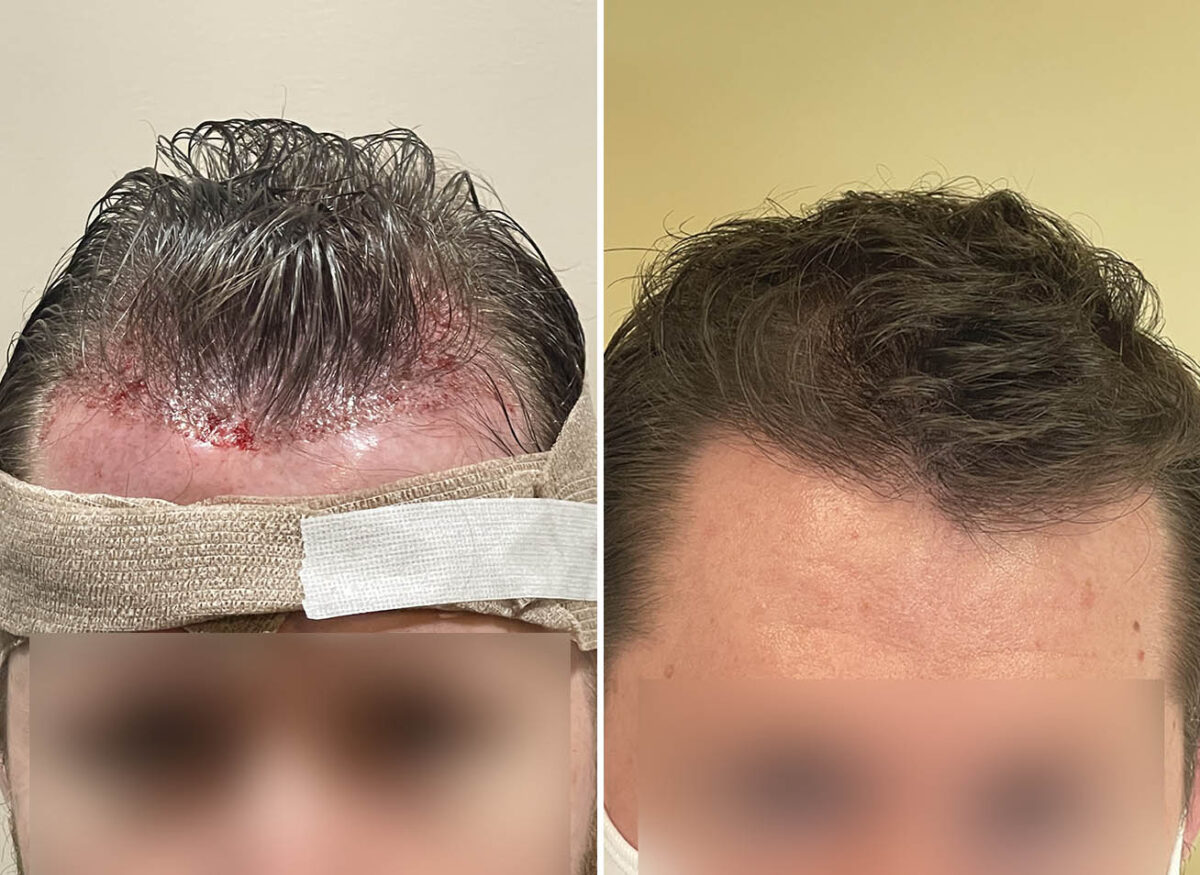 Before And After Transformation With Fue Hair Transplant Cova Hair