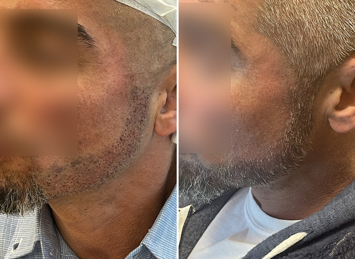 Male Facial FUE Hair Transplant | CoVa Hair