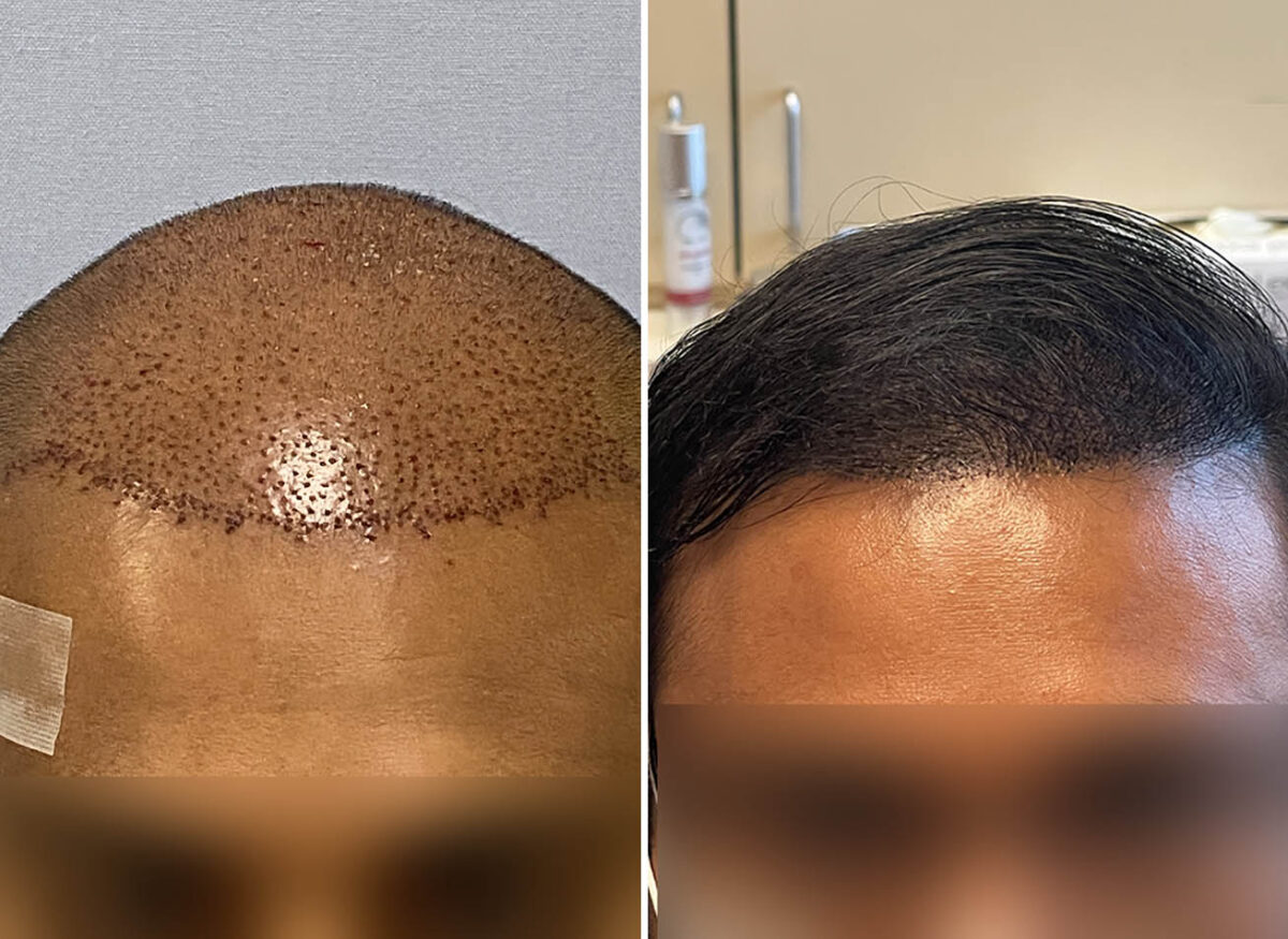 Male FUE Hair Transplant | CoVa Hair