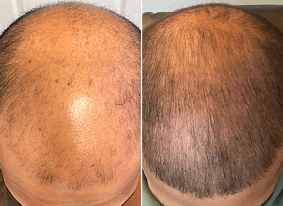 Male FUE Hair Transplant | CoVa Hair