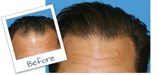 hair transplant before and after in Florida