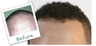 hair transplant before and after in New York