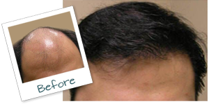 Before and After Hair transplant