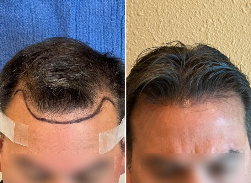 Before And After: Hair Transplant Transformation At Age 53 | CoVa Hair