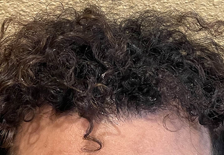 After FUE Hair transplant