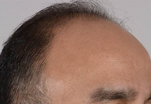 Hair Transplant Before and After