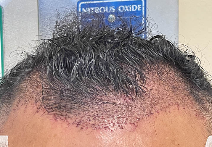 Before FUE Hair transplant