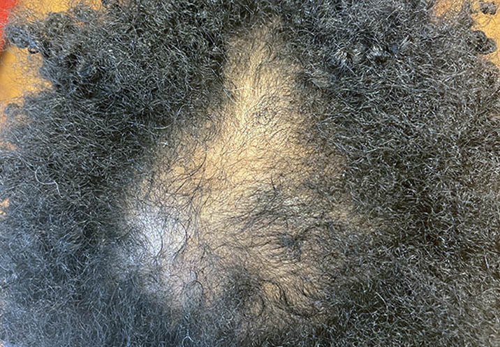 Before FUE Hair transplant