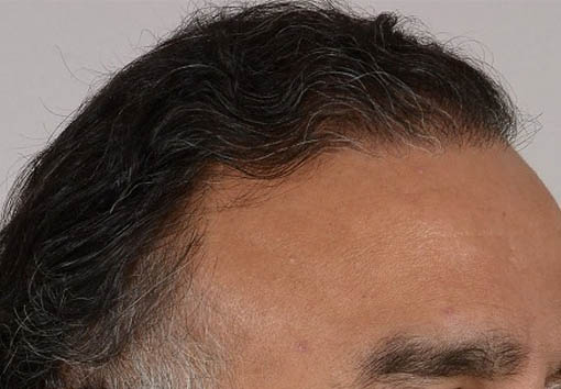 Hair Transplant Before and After