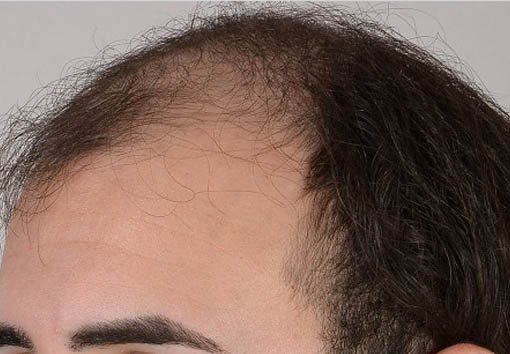 Before FUT Hair transplant