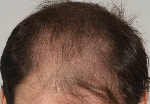 Before FUT Hair transplant