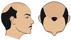 male hair loss example