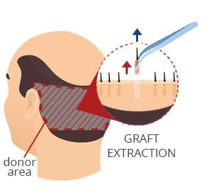 FUE Hair Extraction