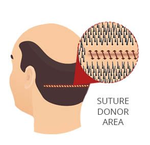 FUT Donor Area