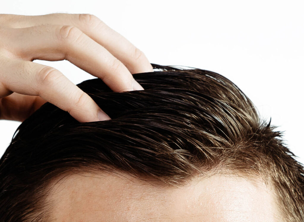 Continuously Evolving Hair Transplant Industry