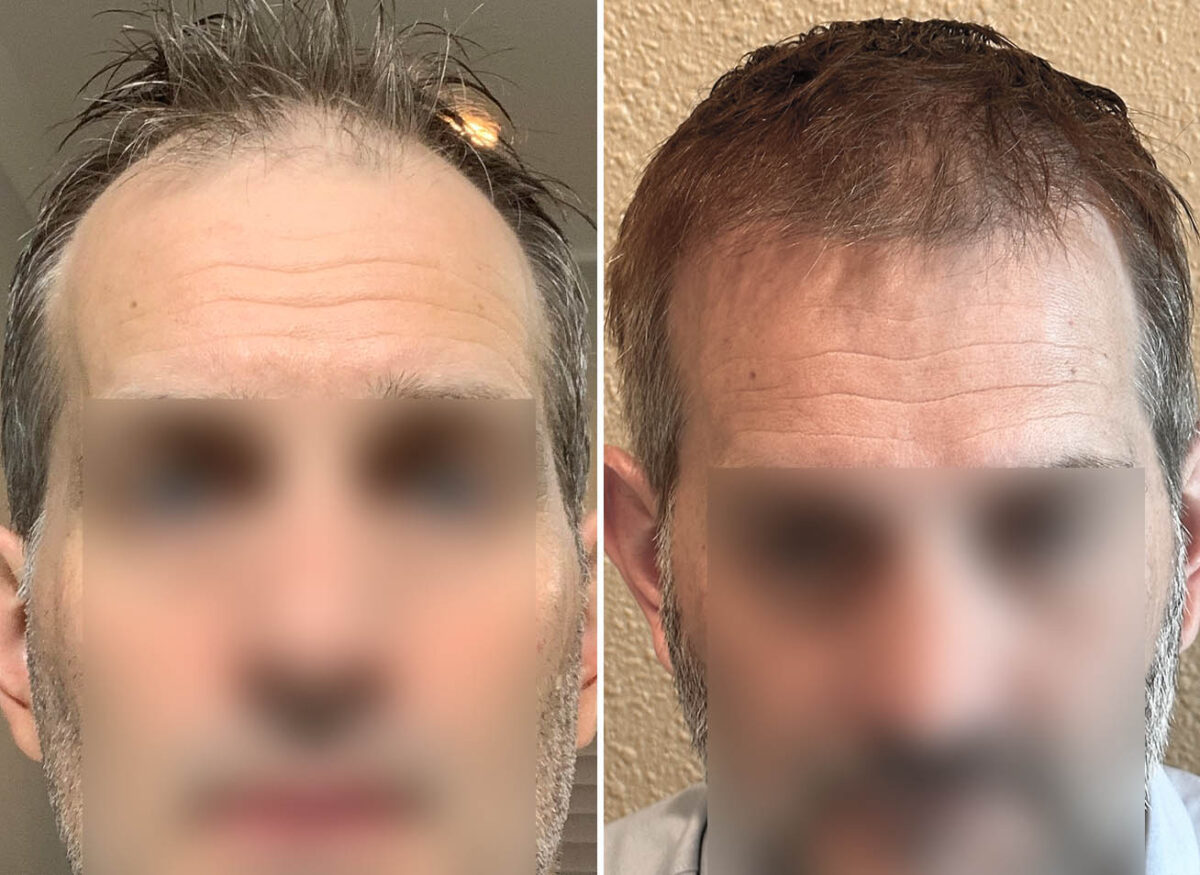 Male Fue Hair Transplant Cova Hair