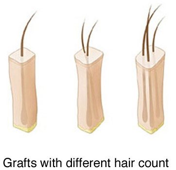 follicular unit hair grafts