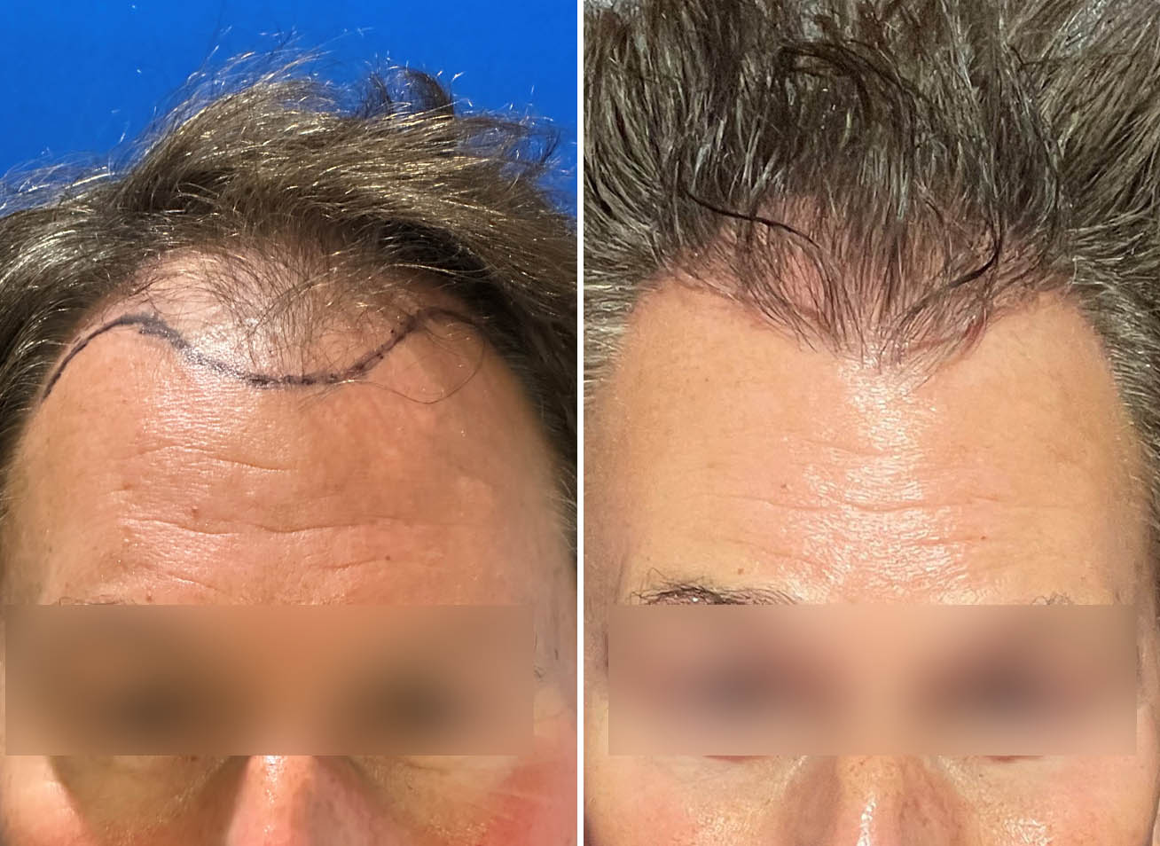 Cova hair transplant before and after