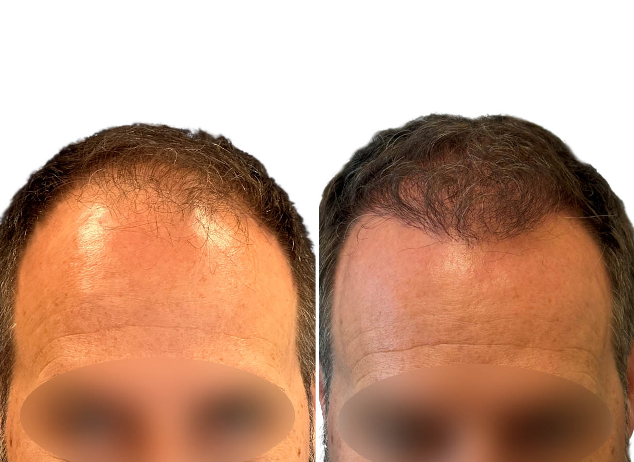 Cova hair transplant before and after